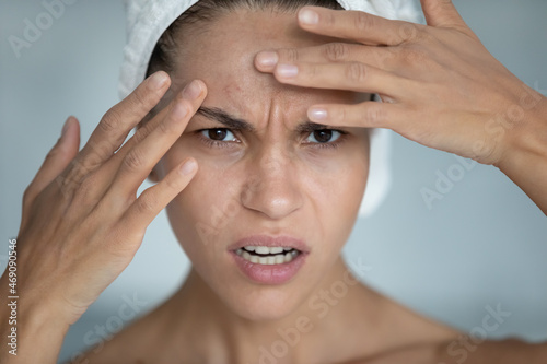 Close up head shot portrait of stressed young mixed race hispanic woman touching forehead, worrying about age related derma skin problems, first mimic wrinkles or acne pimples, annoyed by blackheads.