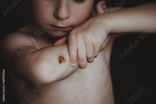 The boy examines the abrasion on his elbow.