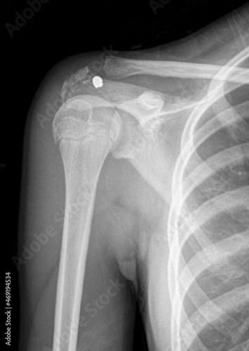 x ray of corpus alienum bullet on shoulder after gun shot photo