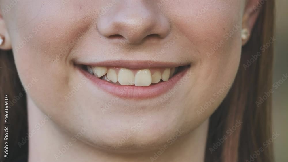 A teenage girl demonstrates her crooked teeth. A teenage girl demonstrates her crooked teeth.