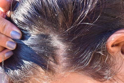 Woman's hair close-up with Dandruff, hair problem concept