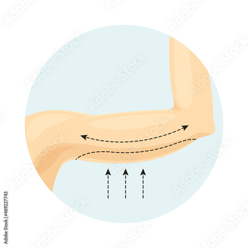 Liposuction of arms. Plastic or cosmetic surgery vector illustration