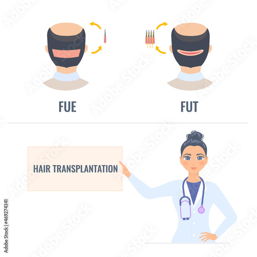 Hair transplantation placard in hands of a woman doctor. FUT and FUE male alopecia treatment infographics. Follicular unit extraction versus follicular unit transplantation. Vector illustration.
