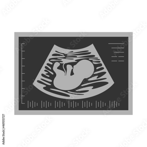 grey ultrasound picture of fetus