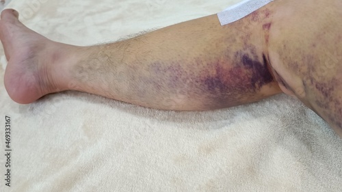bruised skin on leg of patient, patient skin after knee surgery process, rehabilitation and treatment care, wound of patient after treatment with Minimally Invasive Surgery, anterior cruciate ligament