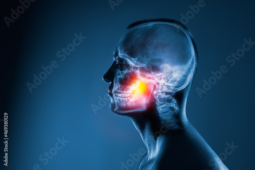 X-ray of a man's head on blue background. Jaw joint is highlighted by yellow red colour. photo