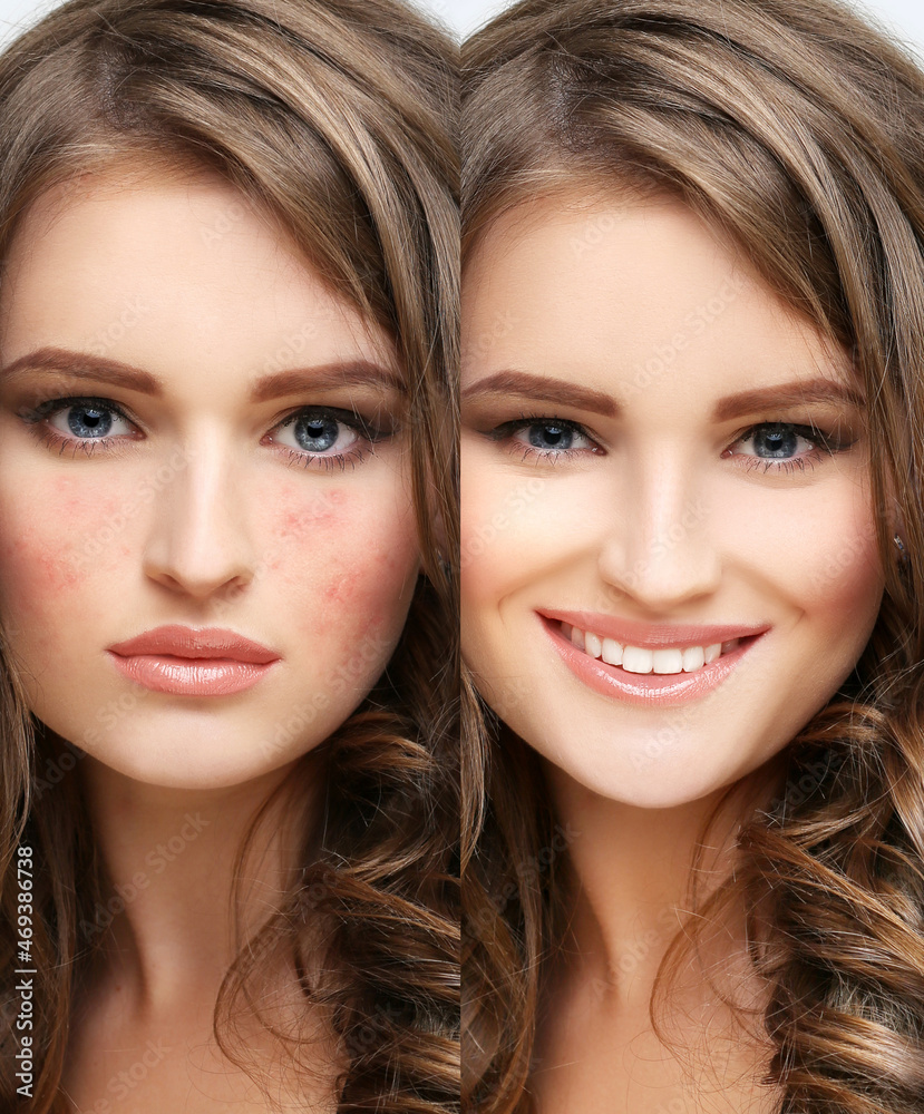 Post-Acne Marks /Treating Acne Scars Post-Acne Marks /Treating Acne Scars