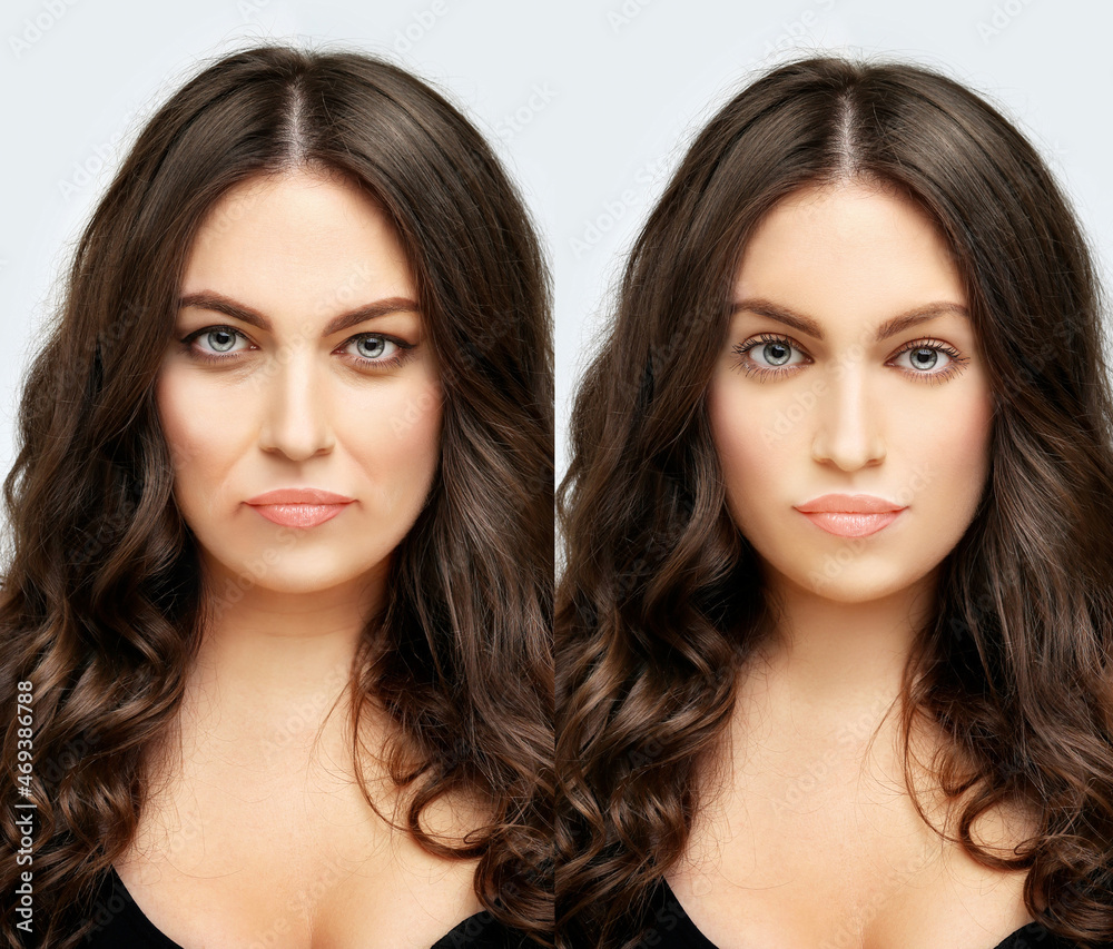 Effects of ageing,Nasolabial folds,Neck ,Under eye circles,neck lines. Plastic Surgery Results Effects of ageing,Nasolabial folds,Neck ,Under eye circles,neck lines. Plastic Surgery Results