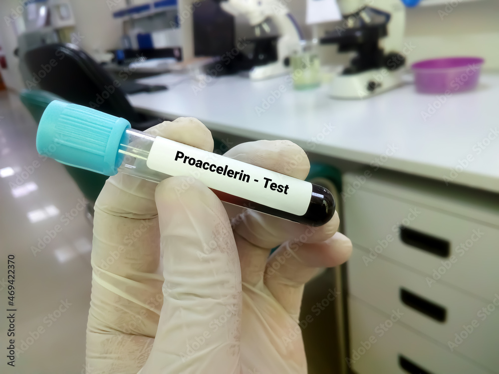 Blood sample for proaccelerin or factor v or labile factor test, diagnosis of coagulation disorder