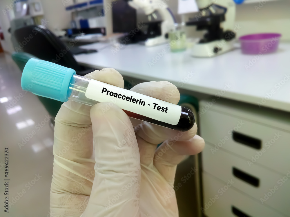 Blood sample for proaccelerin or factor v or labile factor test, diagnosis of coagulation disorder Blood sample for proaccelerin or factor v or labile factor test, diagnosis of coagulation disorder