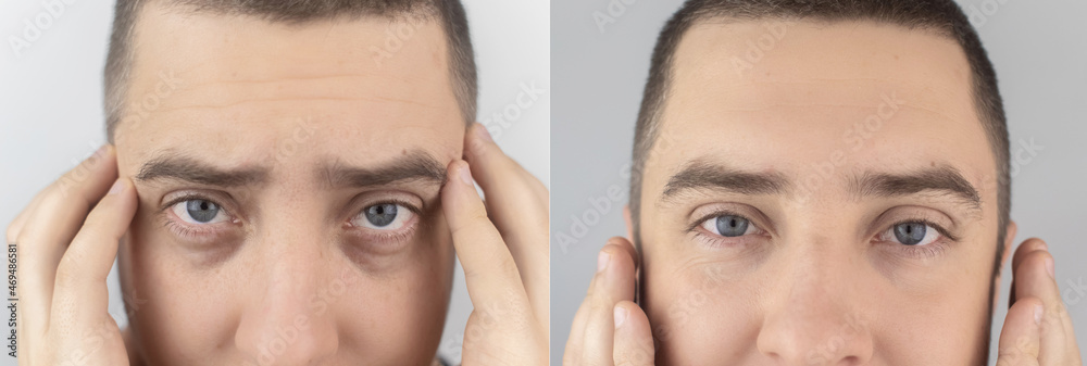Before and after. Bags under eyes, hernias on the man face. Patient being examined by a plastic surgeon. Before and after blepharoplasty. Puffiness, skin folds and varicose veins in the eyelids - obrazy, fototapety, plakaty 