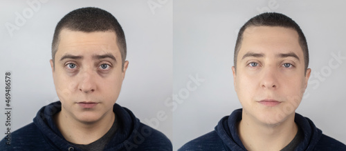 Before and after. Bags under eyes, hernias on the man face. Patient being examined by a plastic surgeon. Before and after blepharoplasty. Puffiness, skin folds and varicose veins in the eyelids photo