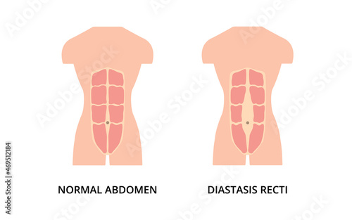 Normal toned abdomen muscles of man and diastasis recti, also known as abdominal separation. Male body, health, sport 