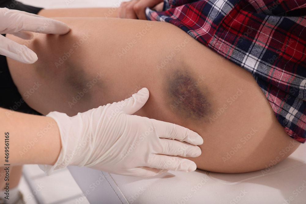 Fototapeta premium Doctor examining patient's bruised hip in hospital, closeup