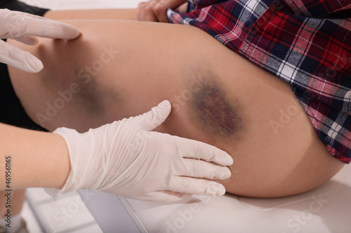 Doctor examining patient's bruised hip in hospital, closeup