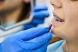 Close-up of dentist uses interdental brush and cleaning dental braces of teenage girl at dental clinic.