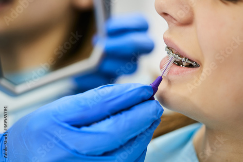 Close-up of dentist uses interdental brush and cleaning dental braces of teenage girl at dental clinic.