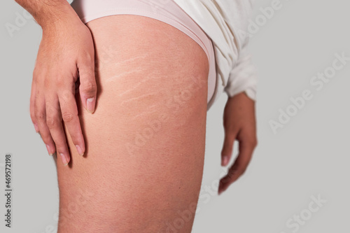 Latin woman leg shows her stretch marks fearlessly. Body positive concept.