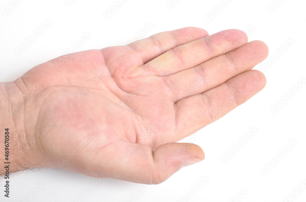 Dupuytren's contracture, also called Dupuytren's disease, Morbus Dupuytren, Viking disease, and Celtic hand. On white background. Dupuytren's contracture, also called Dupuytren's disease, Morbus Dupuytren, Viking disease, and Celtic hand. On white background.