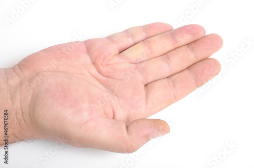 Dupuytren's contracture, also called Dupuytren's disease, Morbus Dupuytren, Viking disease, and Celtic hand. On white background.