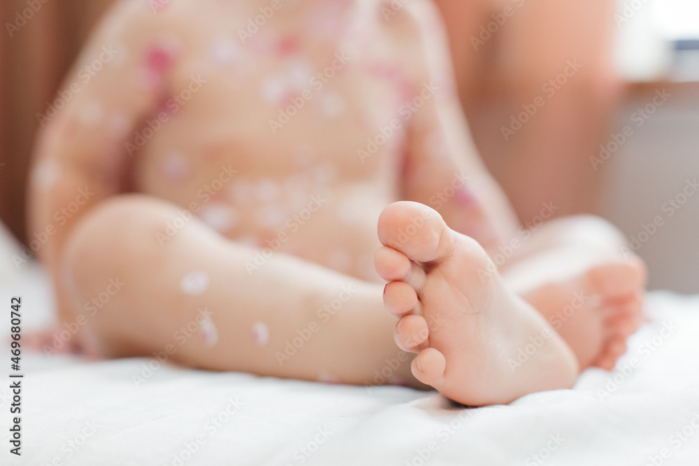 Children's legs with chickenpox. Close-up of the legs. bare children's feet on white Children's legs with chickenpox. Close-up of the legs. bare children's feet on white
