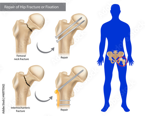 Repair of Hip Fracture or Fixation. Intertrochanteric fracture or Femoral neck fracture. Broken Hip photo