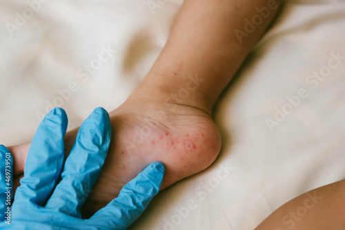 Rash of enterovirus infection picornavirus families on the feet of a 3-year-old child. Medicine, health concept. photo