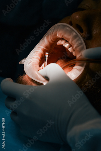 close-up of the process of implantation of teeth and tooth in a dental clinic operation 