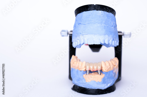 Tooth recovery with implant. Veneers and crowns on gypsum dental artificial jaw on grey background. Plaster model of teeth. White front teeth veneers on diagnostic model. Concept of aesthetic