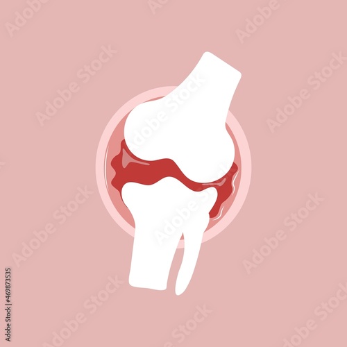 Illustrative flat vector of arthritis