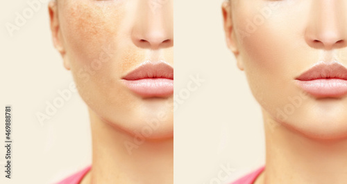 Dark spots, freckles,hyperpigmentation(melasma or chloasma).