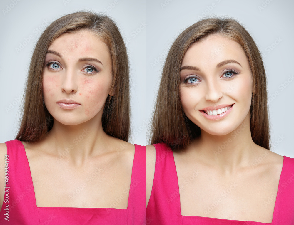 Post-Acne Marks .Treating Acne Scars.Acne Scar Removal.