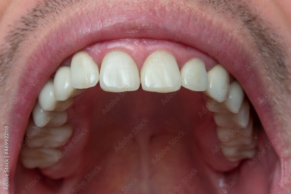 Obraz premium Caucasian male opened mouth close up macro shot. Row of with teeth, visible oral cavity, unrecognizable face