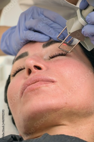 Laser skin rejuvenation, eyelid correction, pigmentation removal, close-up