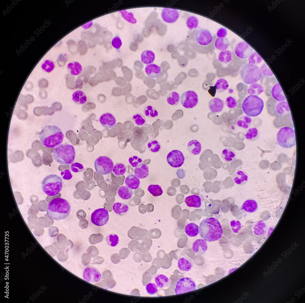 Blood Cancer Chronic Myelogenous Leukemia Also Known As Chronic Blood Cancer Chronic Myelogenous Leukemia Also Known As Chronic