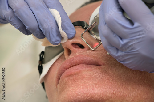 Facial rejuvenation with a laser by a beautician doctor  close up