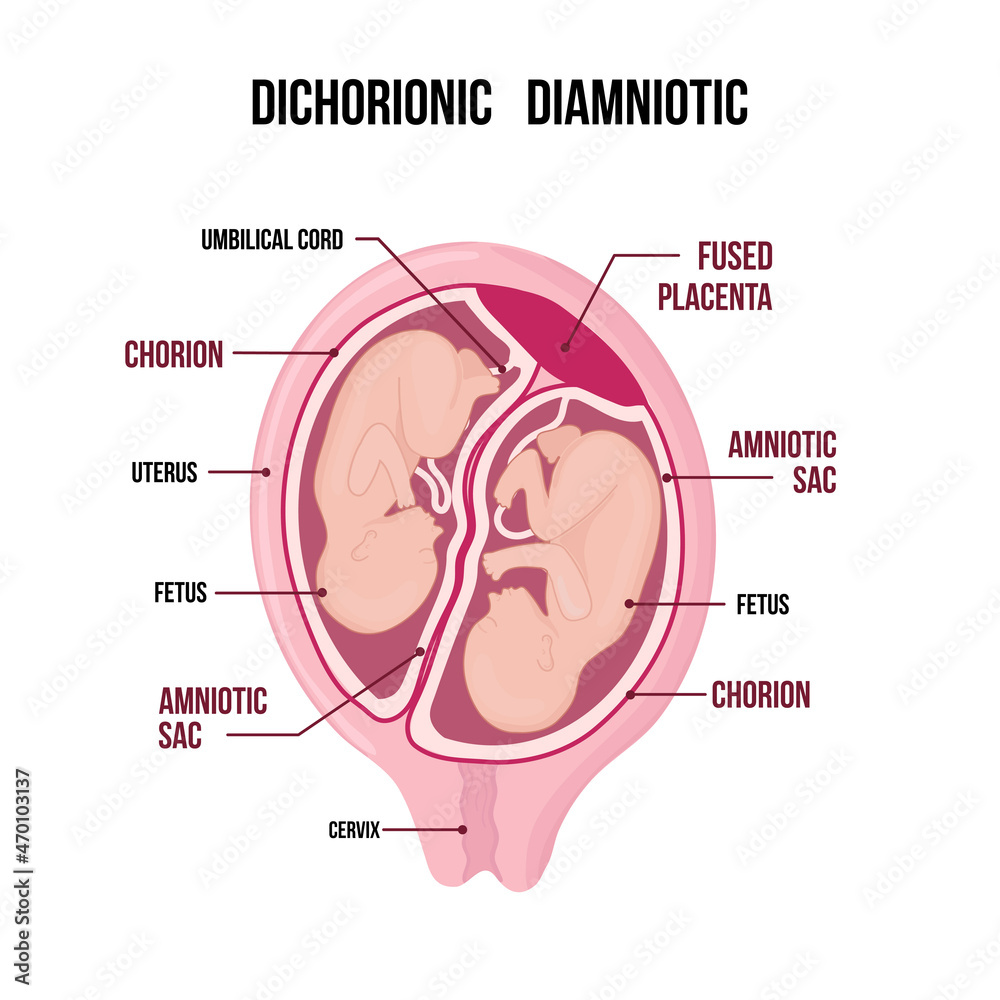 Obraz premium Dichorionic diamniotic twins with fused placenta