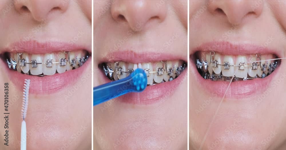 Collage cleaning braces teeth system, closeup. Oral care concept with braces. Woman brushing