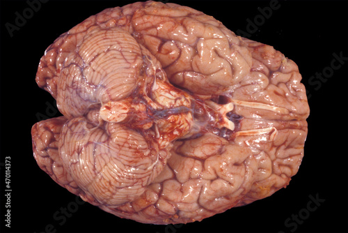 Human brain Subarachnoid basal hemorrhage photo