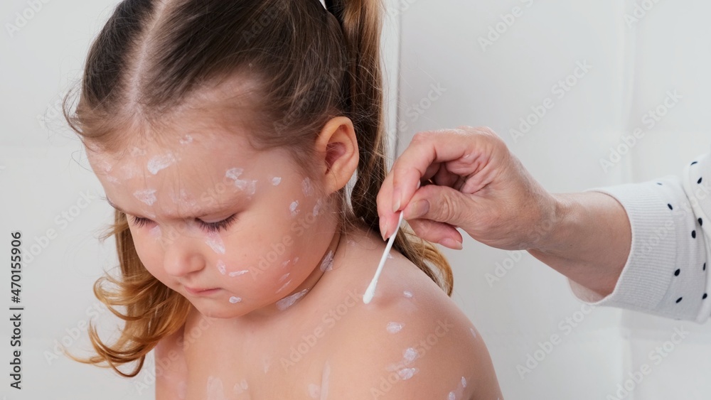 sad little girl with chickenpox, antiseptic cream applied to the rash ...