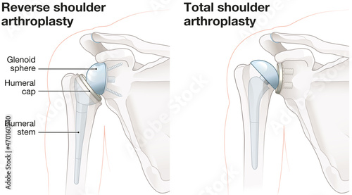 Obraz na płótnie Shoulder arthroplasty. Shoulder replacement. Illustration