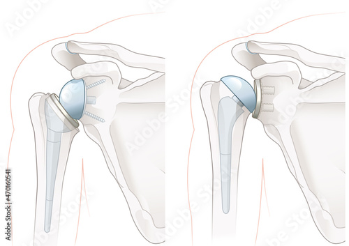 Shoulder arthroplasty. Shoulder replacement. Illustration