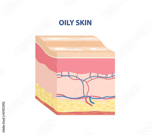 Skin Type Sticker. Colorful icon with layers of skin. Oily epidermis. Sebaceous glands. Design element for cosmetology magazines. Cartoon isometric vector illustration isolated on white background