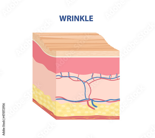 Skin Type Sticker. Age related dermis with wrinkles. Layers of skin with uneven epidermis. Design element for scientific books. Cartoon isometric vector illustration isolated on white background