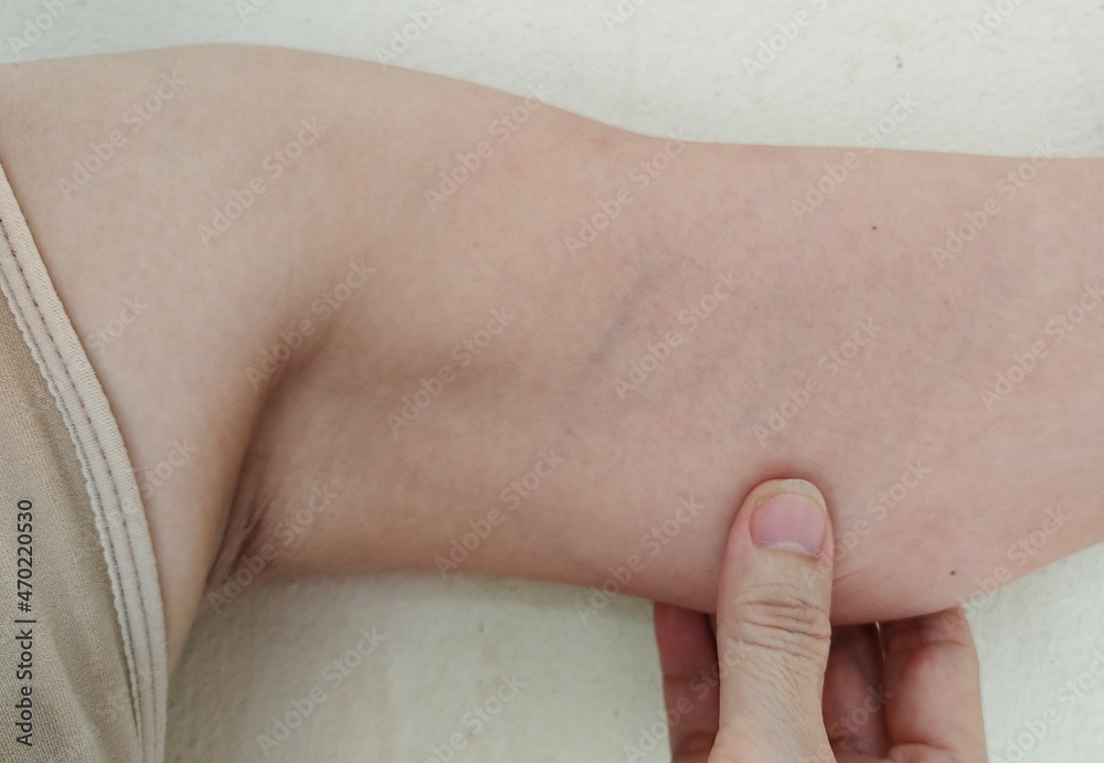 close up the hand squeezing sagging under the arm, black armpit, skin problem of woman. close up the hand squeezing sagging under the arm, black armpit, skin problem of woman.