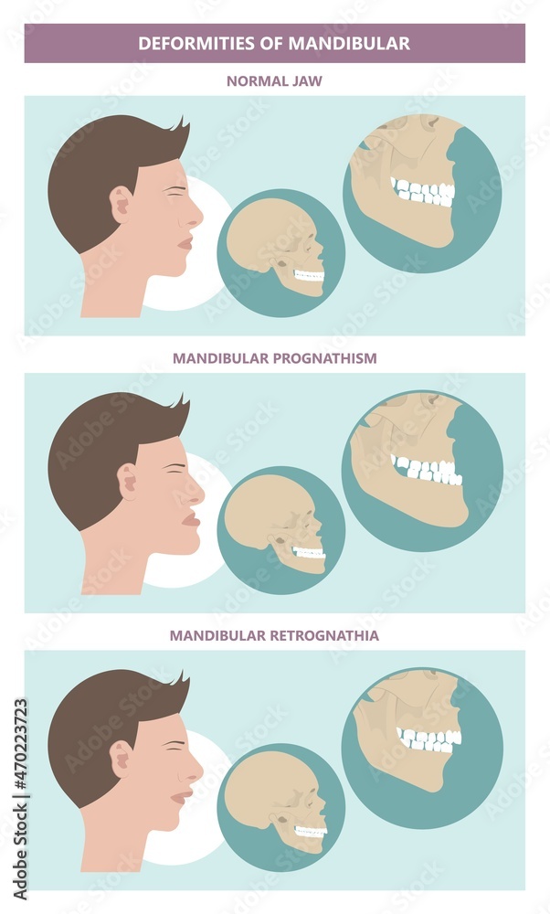 Jaw Surgery chin implant Sleep Apnea snoring upper airway plastic