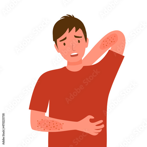 Young man scratching his body and back. Guy suffering from strong allergy skin itchy symptom in flat design. Red rash skin irritation.