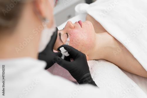 Closeup of cosmetologist doctor making anti-aging injections of a young girl. The beautician does the biorevitalization procedure on the face  blood from injections is visible on the skin