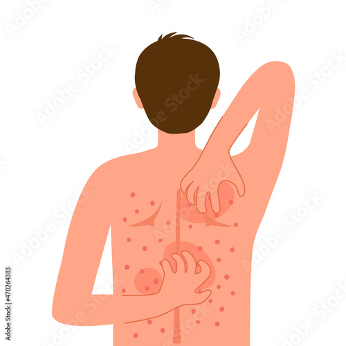 Young man scratching his back. Guy suffering from strong allergy skin itchy symptom in flat design. Red rash skin irritation.