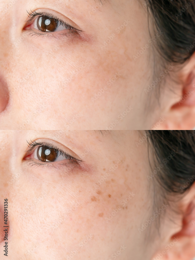 Fototapeta premium シミ・肌